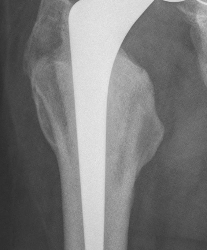 Type 2 Cemented Femur